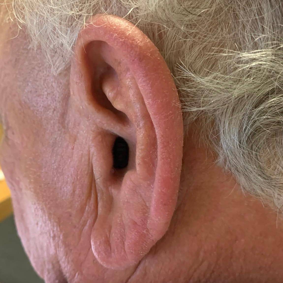 Discrição do aparelho auditivo invisível